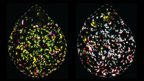 After surgery, tumour tissue is cut into small pieces (~0.5 mm) and cultured for ~1 week. Using these organoids, we investigate how the proportion of quiescent/‘sleeping’ glioblastoma stem cells changes in response to various drug treatments. This information is invaluable in directing us in our mission to improve current treatment strategies for glioblastoma. Abundance of quiescent glioblastoma stem cells (green) and actively-dividing glioblastoma stem cells (magenta). Red cells are non-stem cells.