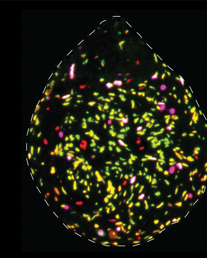 After surgery, tumour tissue is cut into small pieces (~0.5 mm) and cultured for ~1 week. Using these organoids, we investigate how the proportion of quiescent/‘sleeping’ glioblastoma stem cells changes in response to various drug treatments. This information is invaluable in directing us in our mission to improve current treatment strategies for glioblastoma. Abundance of quiescent glioblastoma stem cells (green) and actively-dividing glioblastoma stem cells (magenta). Red cells are non-stem cells.